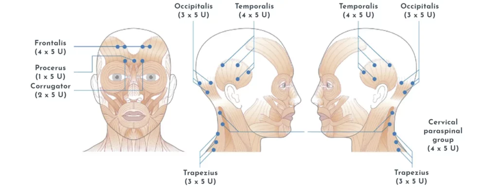 Botox infiltraties voor chronische migrane bij Ahead Clinic Ref: Toxicon 2016; Botulinum toxin for chronic migraine: Clinical trials and technical aspects; C Tassorelli et al.